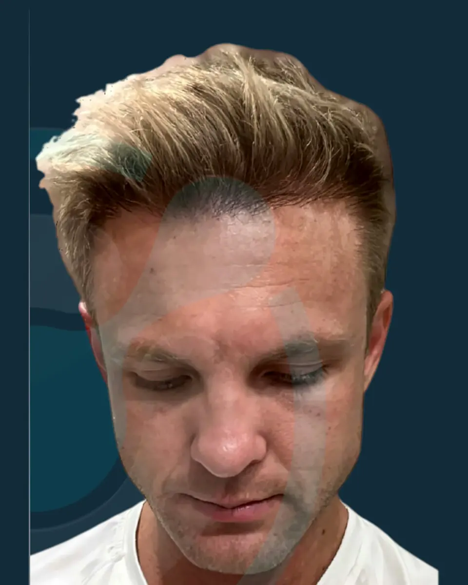 Prima e dopo un trapianto di capelli, paziente reale di BlueMagic Group, 4.200 innesti, DHI, 1 sessione, 6 mesi