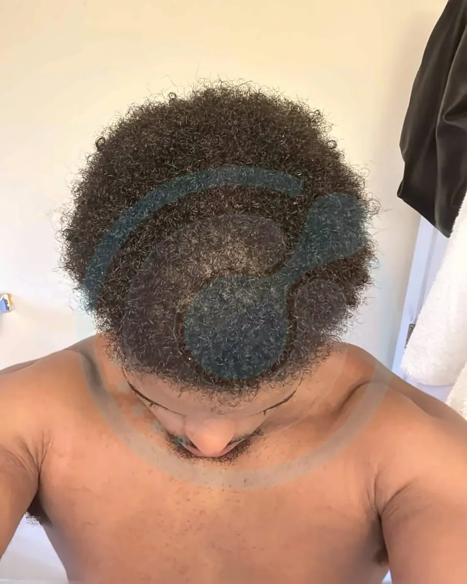 Prima e dopo un trapianto di capelli, paziente reale di BlueMagic Group, DHI, 1 sessione, 10 mesi