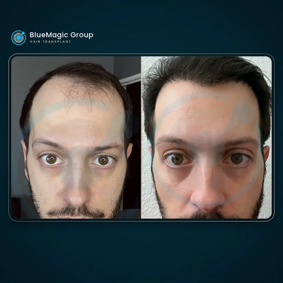 Prima e dopo un trapianto di capelli, paziente reale di BlueMagic Group