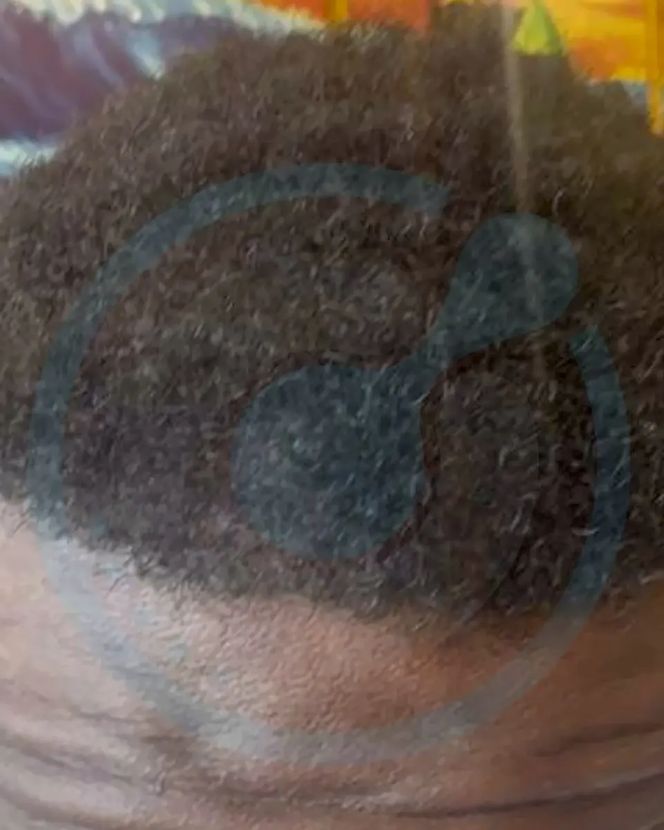 Prima e dopo un trapianto di capelli, paziente reale di BlueMagic Group, 2.500 innesti, DHI, 1 sessione, 12 mesi