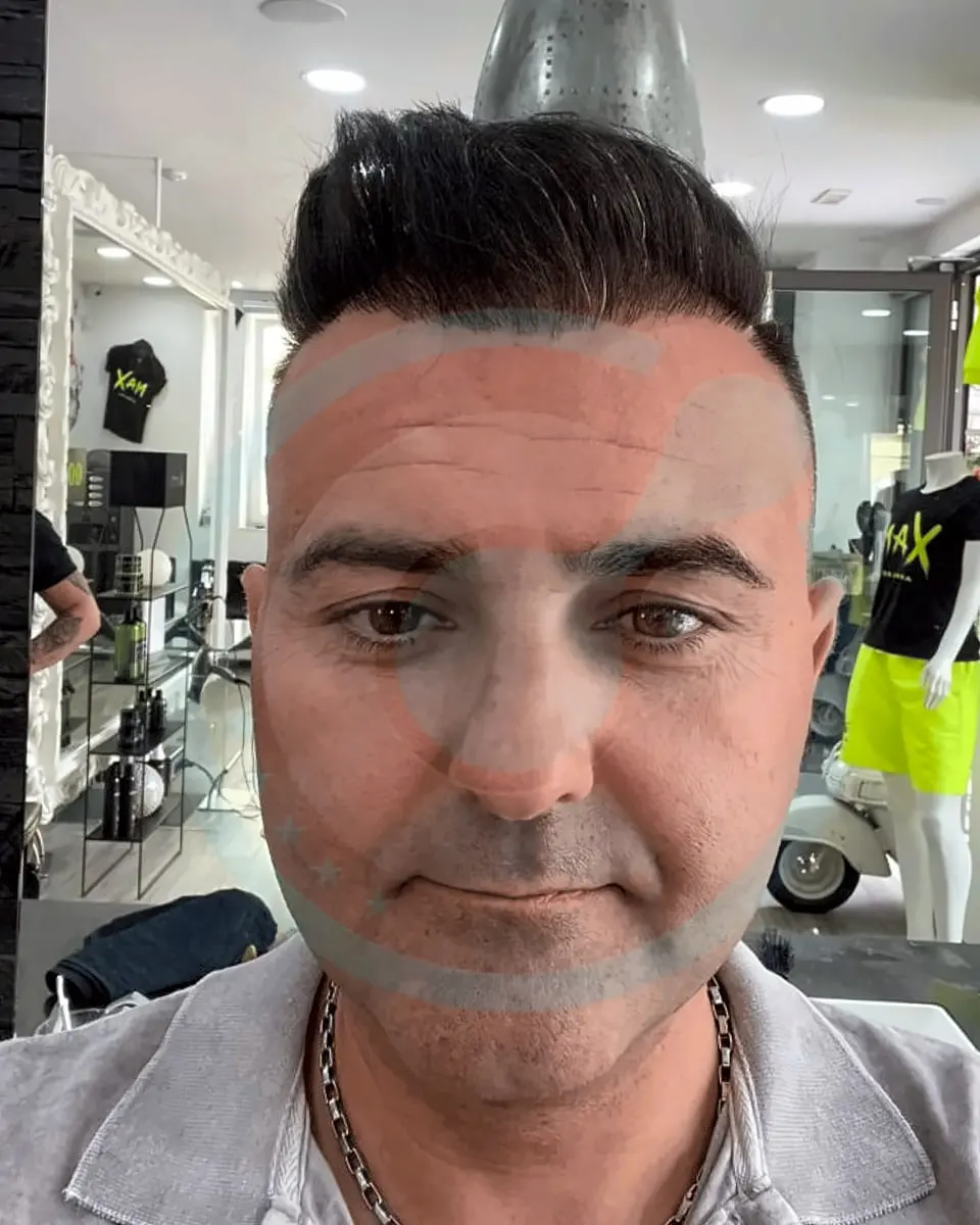Prima e dopo un trapianto di capelli, paziente reale di BlueMagic Group, 5.400 innesti, DHI, 1 sessione, 12 mesi
