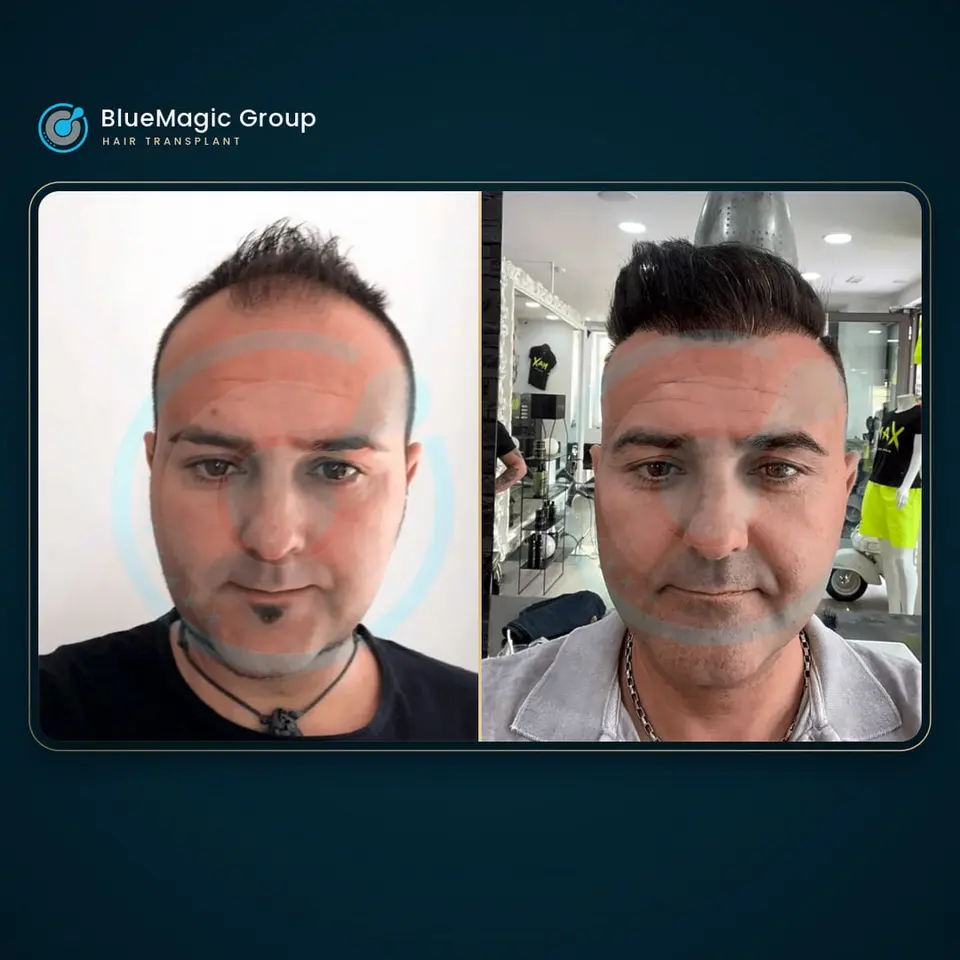 Prima e dopo un trapianto di capelli, paziente reale di BlueMagic Group