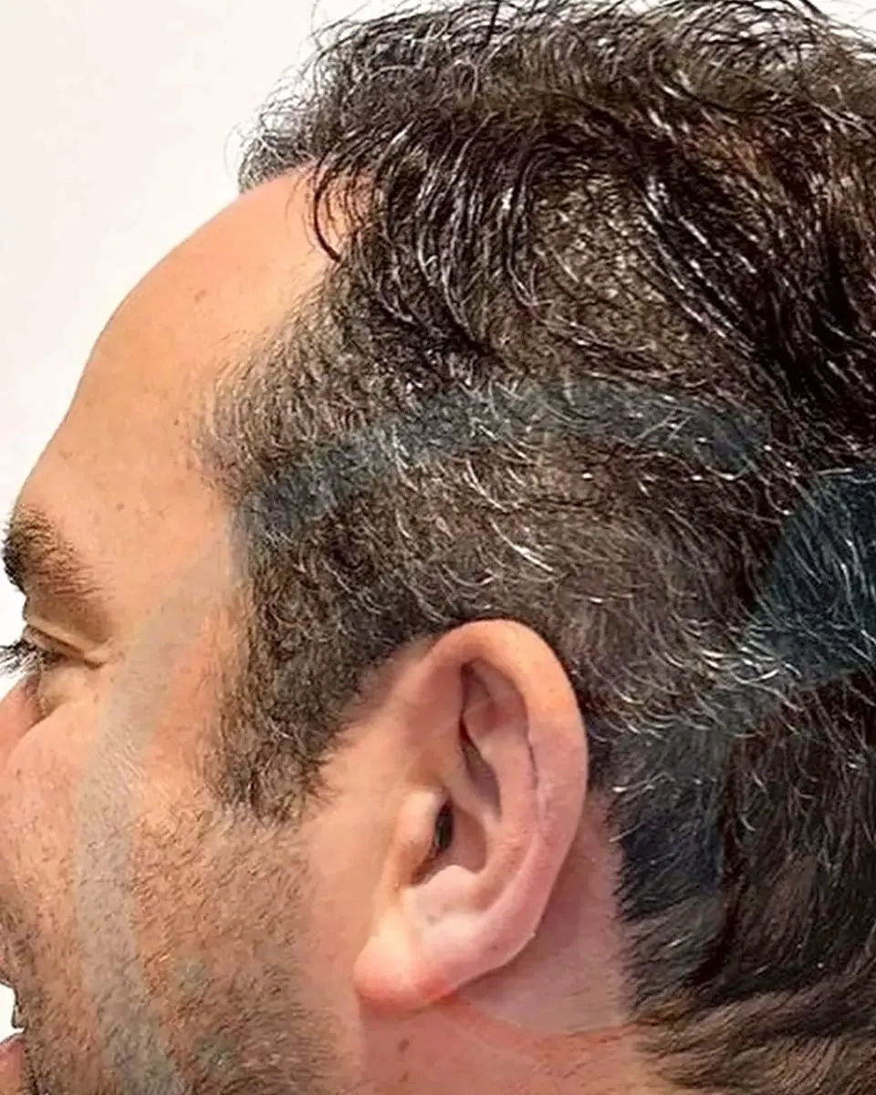 Prima e dopo un trapianto di capelli, paziente reale di BlueMagic Group, 5.000 innesti, DHI, 2 sessioni, 8.5 mesi
