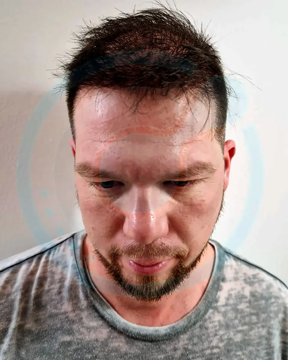 Prima e dopo un trapianto di capelli, paziente reale di BlueMagic Group, 5.900 innesti, DHI, 2 sessioni, 12 mesi