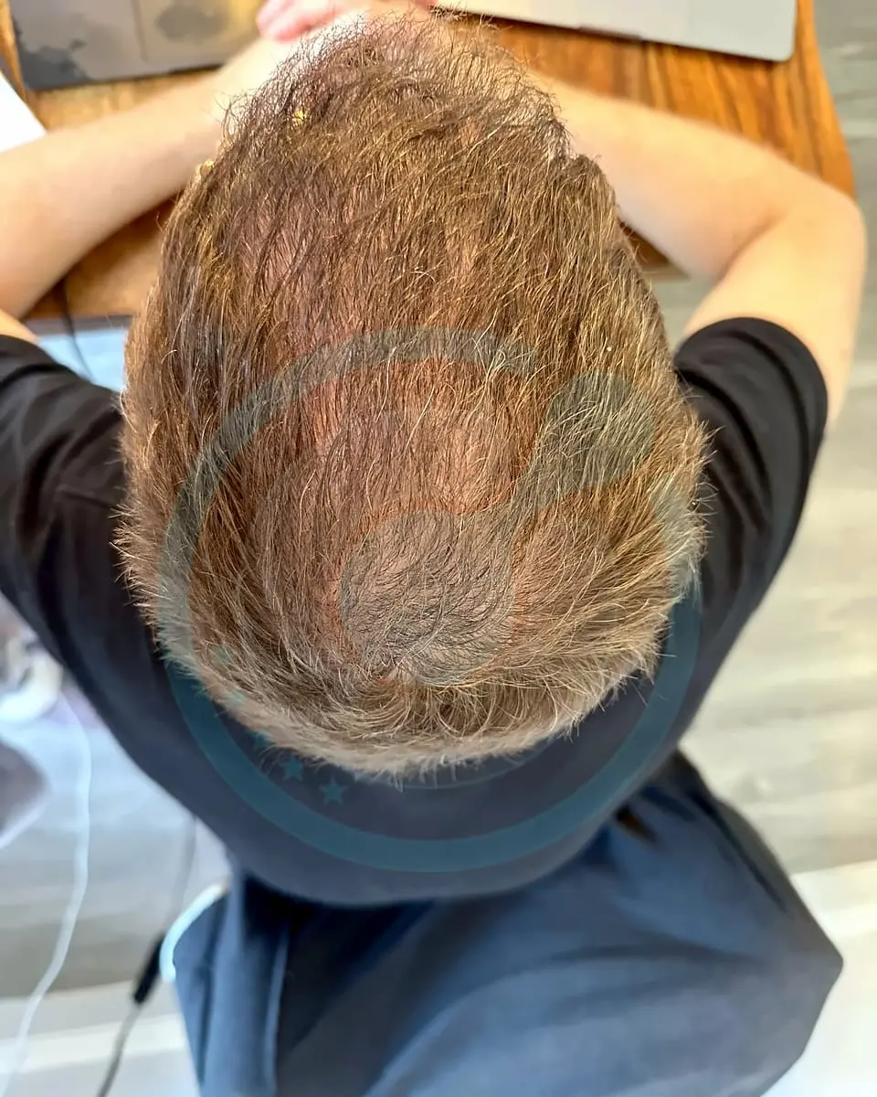 Prima e dopo un trapianto di capelli, paziente reale di BlueMagic Group, 4.000 innesti, DHI, 2 sessioni, 12 mesi