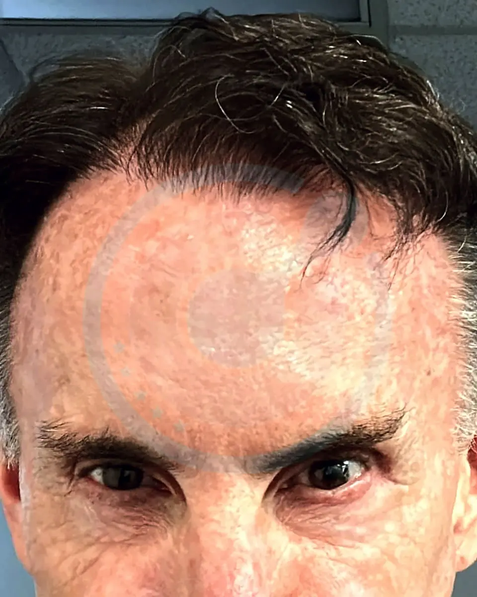 Prima e dopo un trapianto di capelli, paziente reale di BlueMagic Group, 5.400 innesti, Sapphire FUE, 1 sessione, 12 mesi
