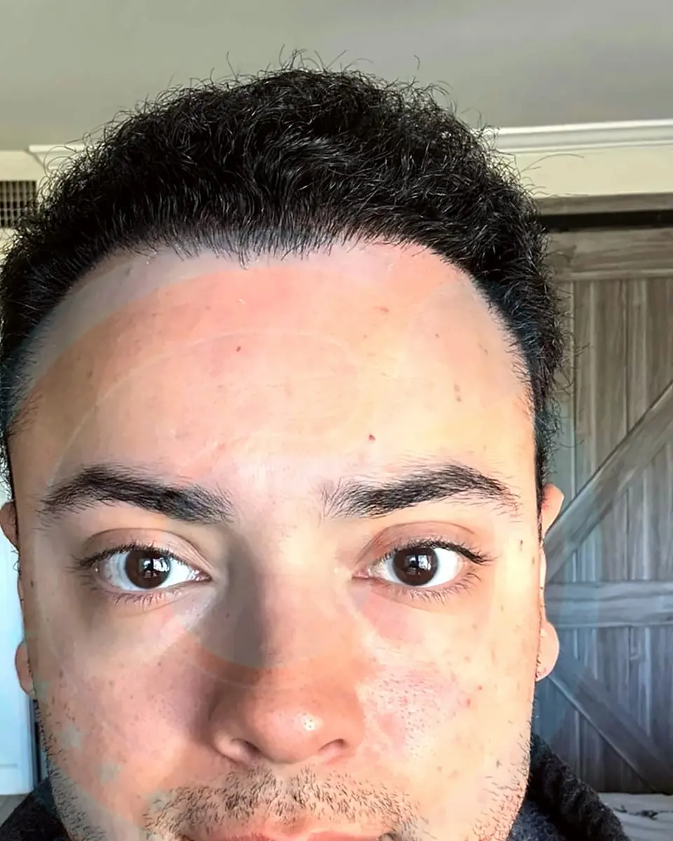 Prima e dopo un trapianto di capelli, paziente reale di BlueMagic Group, 4.300 innesti, DHI, 2 sessioni, 12 mesi