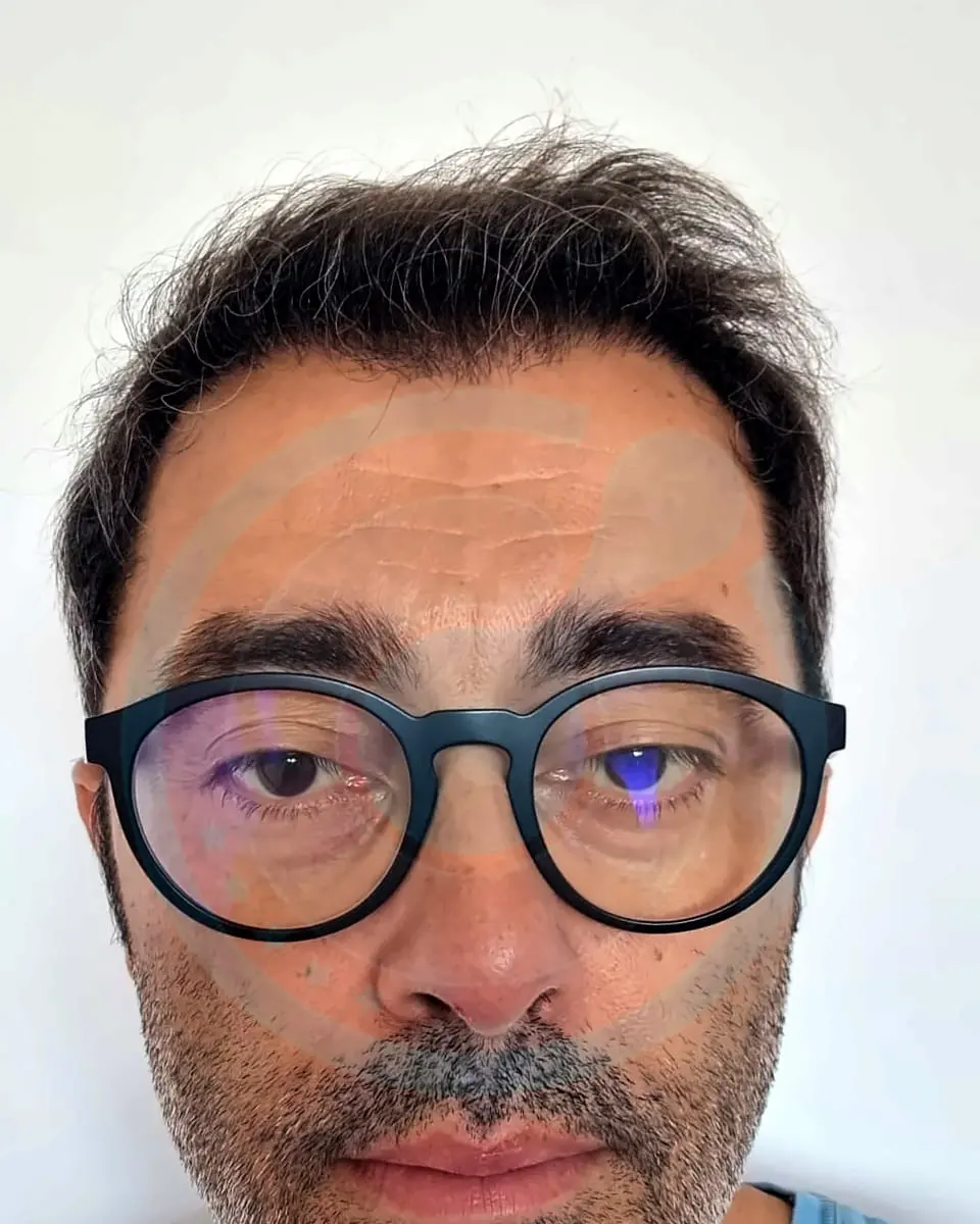 Un paziente reale di BlueMagic Group sei mesi dopo il trapianto di capelli