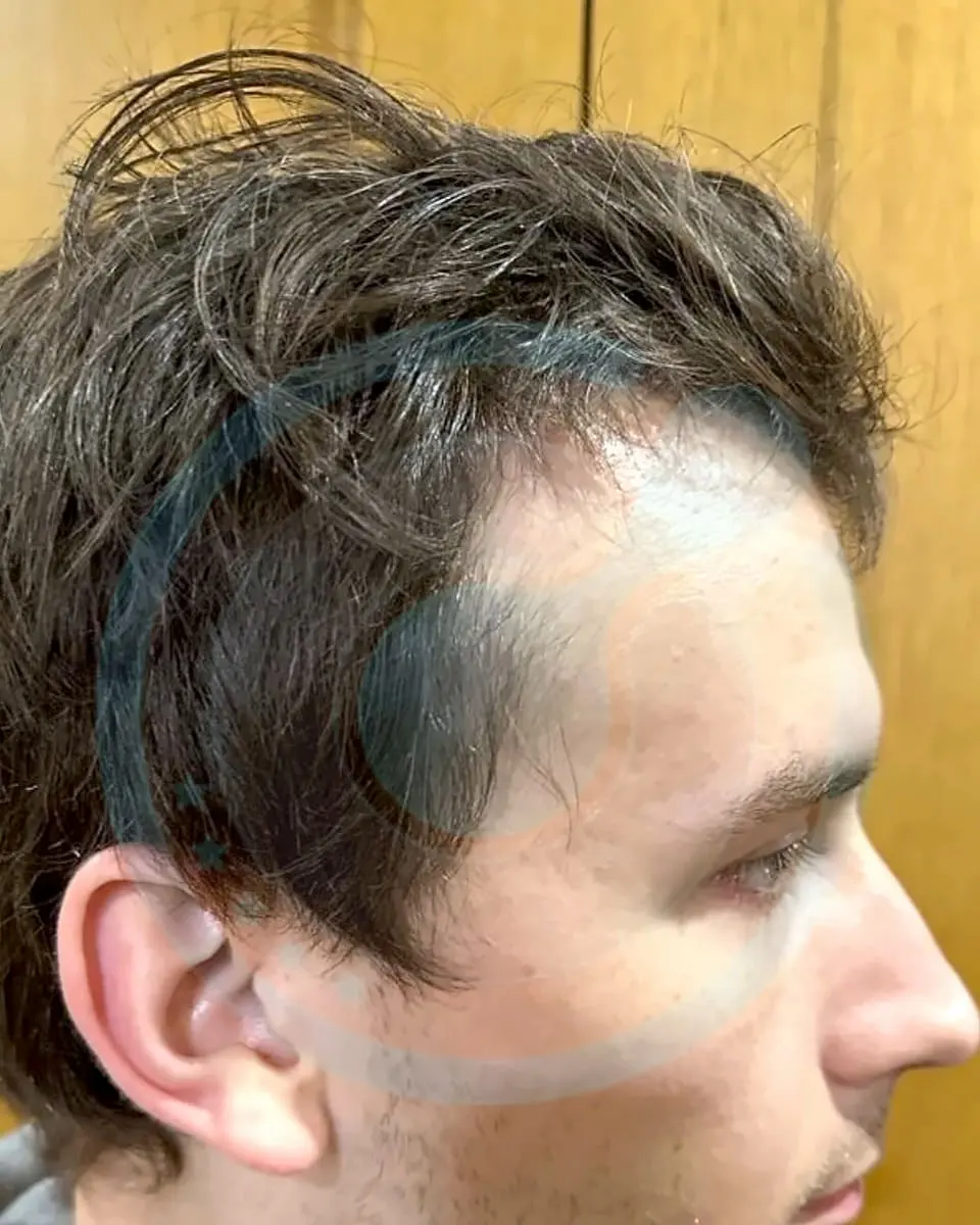 Prima e dopo un trapianto di capelli, paziente reale di BlueMagic Group, 4.300 innesti, DHI, 2 sessioni, 12 mesi