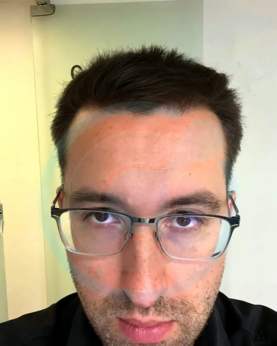 Prima e dopo un trapianto di capelli, paziente reale di BlueMagic Group, 3.700 innesti, DHI, 1 sessione, 8 mesi