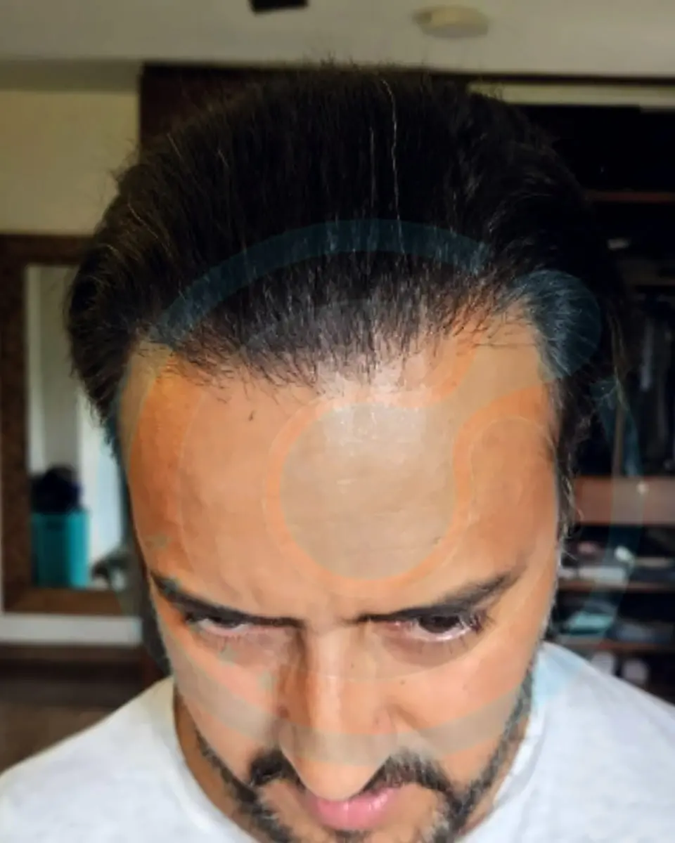 Prima e dopo un trapianto di capelli, paziente reale di BlueMagic Group, 4.600 innesti, DHI, 2 sessioni, 12 mesi