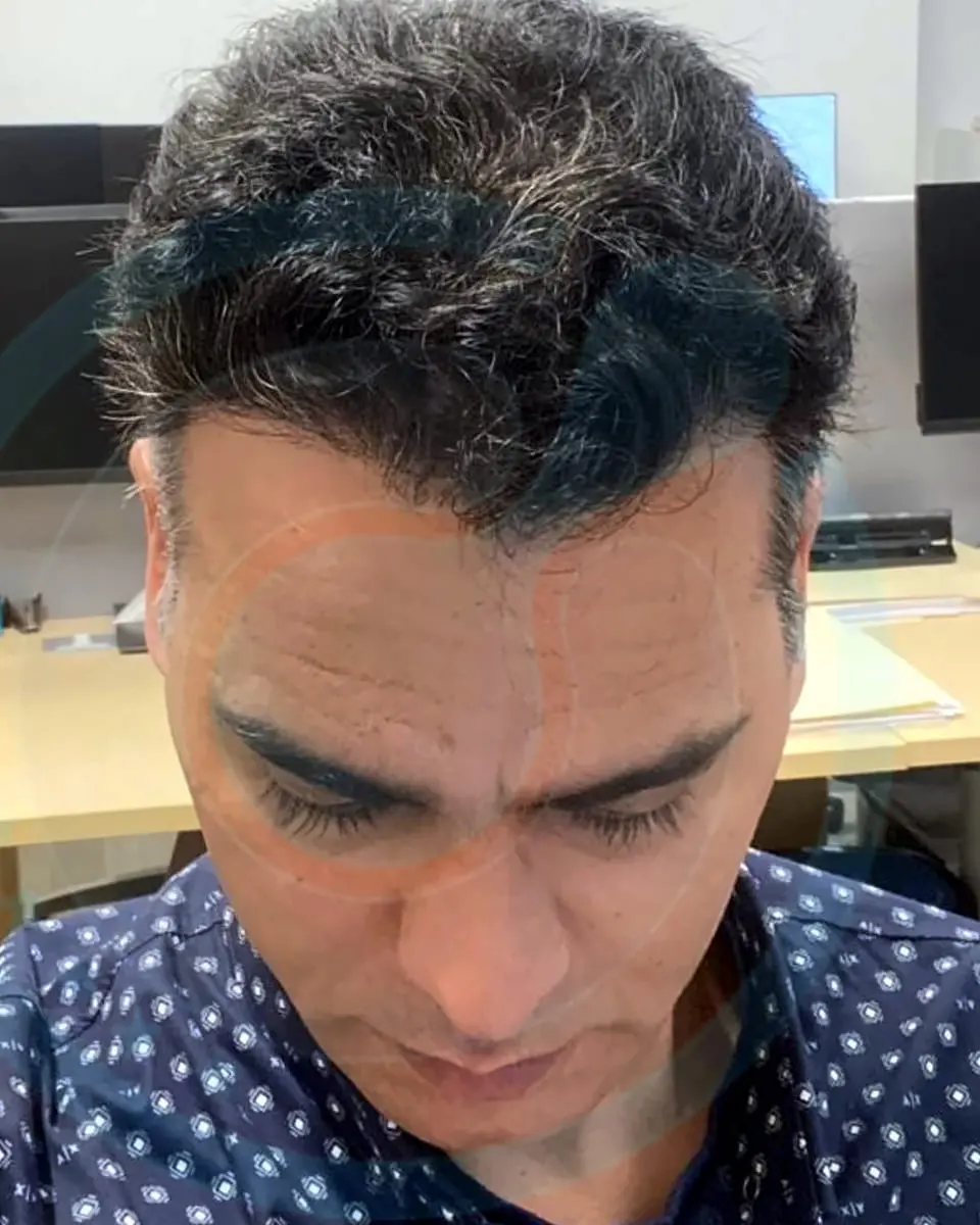 Prima e dopo un trapianto di capelli, paziente reale di BlueMagic Group, 5.300 innesti, DHI, 1 sessione, 12 mesi