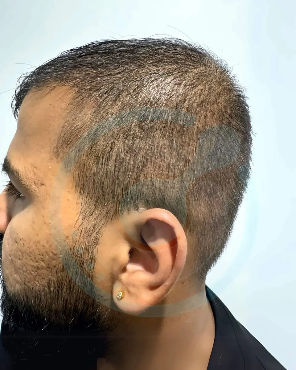 Prima e dopo un trapianto di capelli, paziente reale di BlueMagic Group, 5.300 innesti, DHI, 2 sessioni, 12 mesi