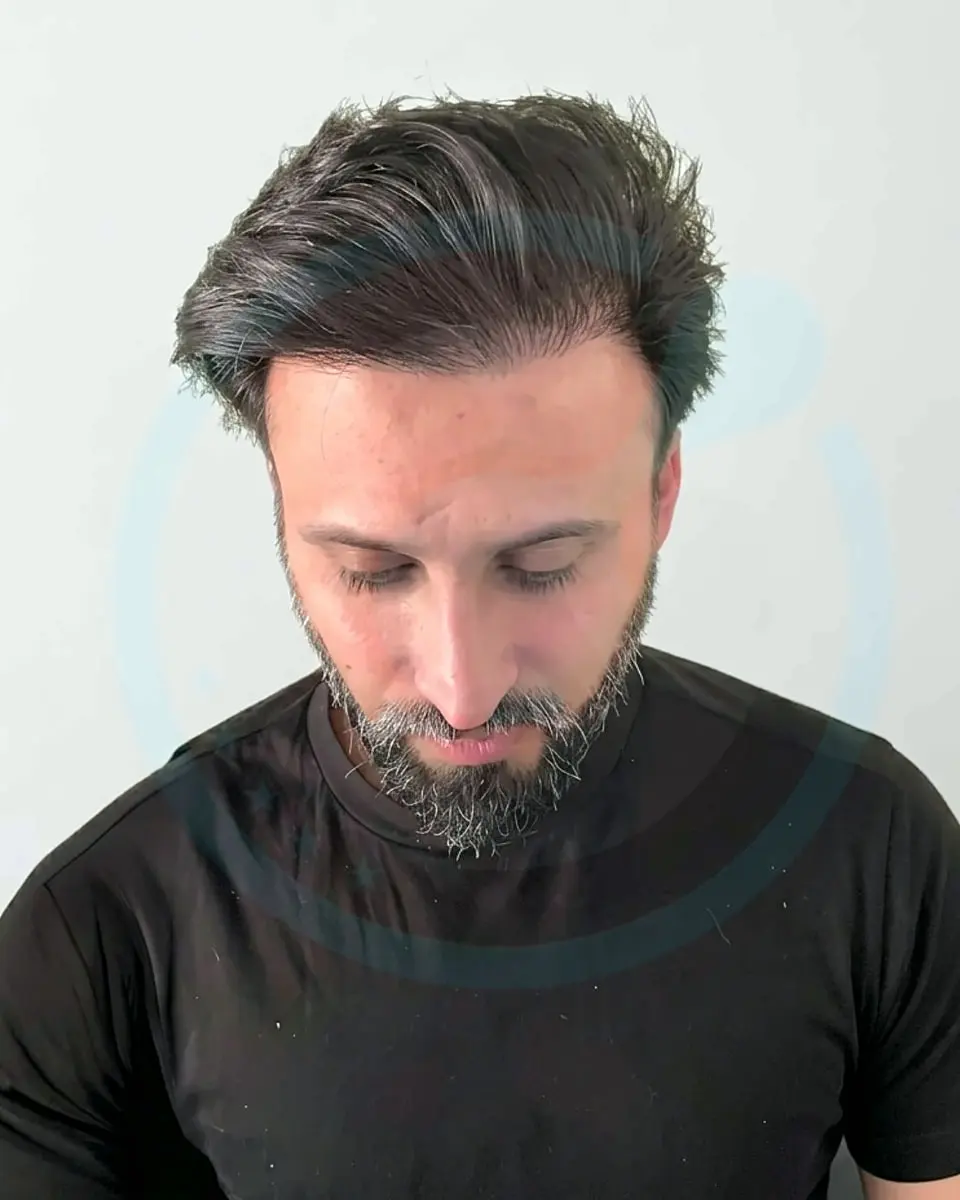 Prima e dopo un trapianto di capelli, paziente reale di BlueMagic Group, 5.800 innesti, DHI, 2 sessioni, 12 mesi