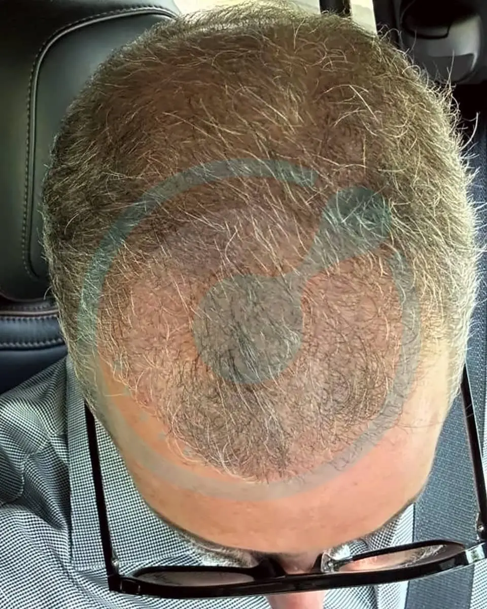 Prima e dopo un trapianto di capelli, paziente reale di BlueMagic Group, 6.200 innesti, DHI, 6 mesi