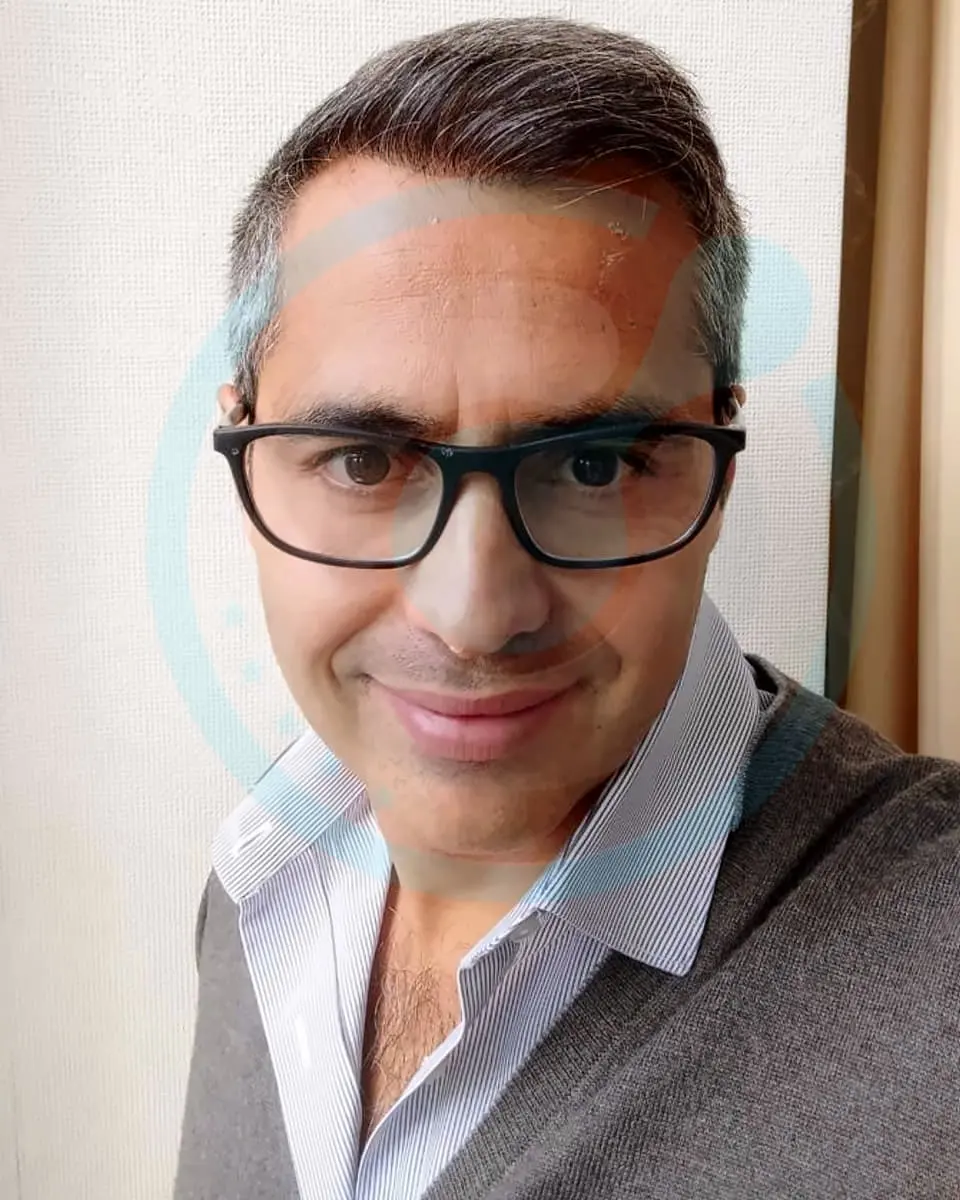 Prima e dopo un trapianto di capelli, paziente reale di BlueMagic Group, 5.700 innesti, DHI, 2 sessioni