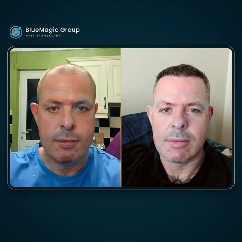 Prima e dopo un trapianto di capelli, paziente reale di BlueMagic Group