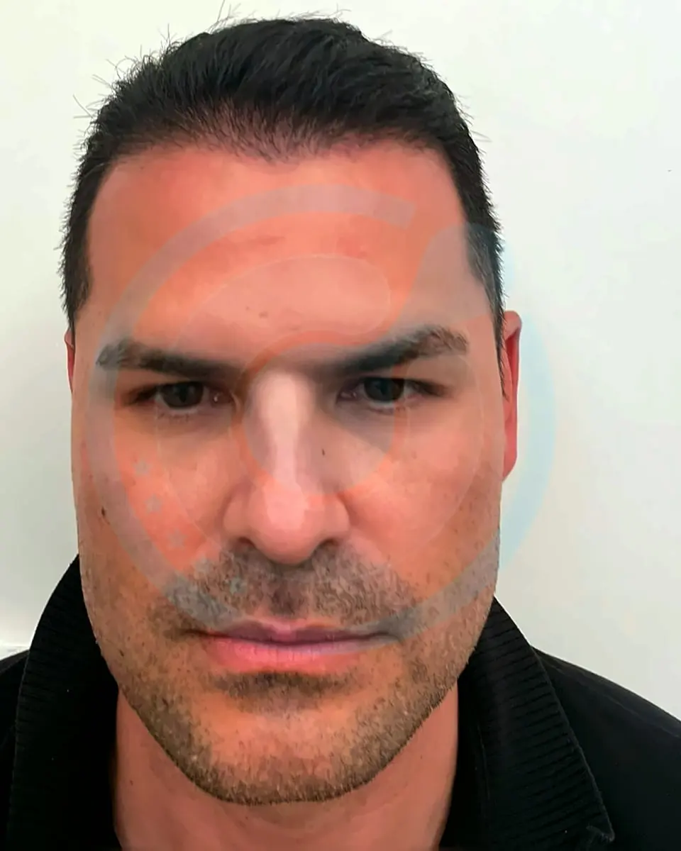 Prima e dopo un trapianto di capelli, paziente reale di BlueMagic Group, 4.600 innesti, DHI, 1 sessione, 6 mesi