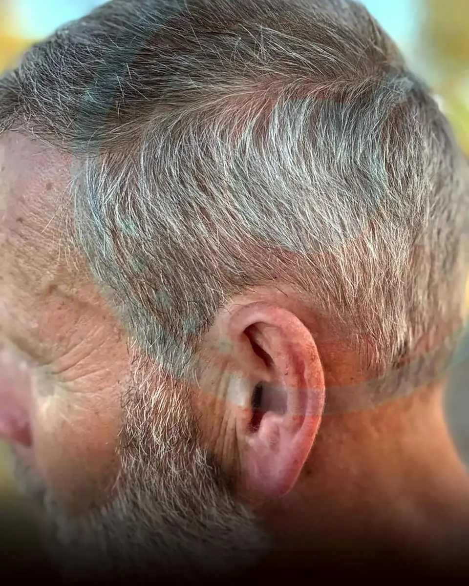 Prima e dopo un trapianto di capelli, paziente reale di BlueMagic Group, 2.500 innesti, Sapphire FUE, 1 sessione, 10 mesi