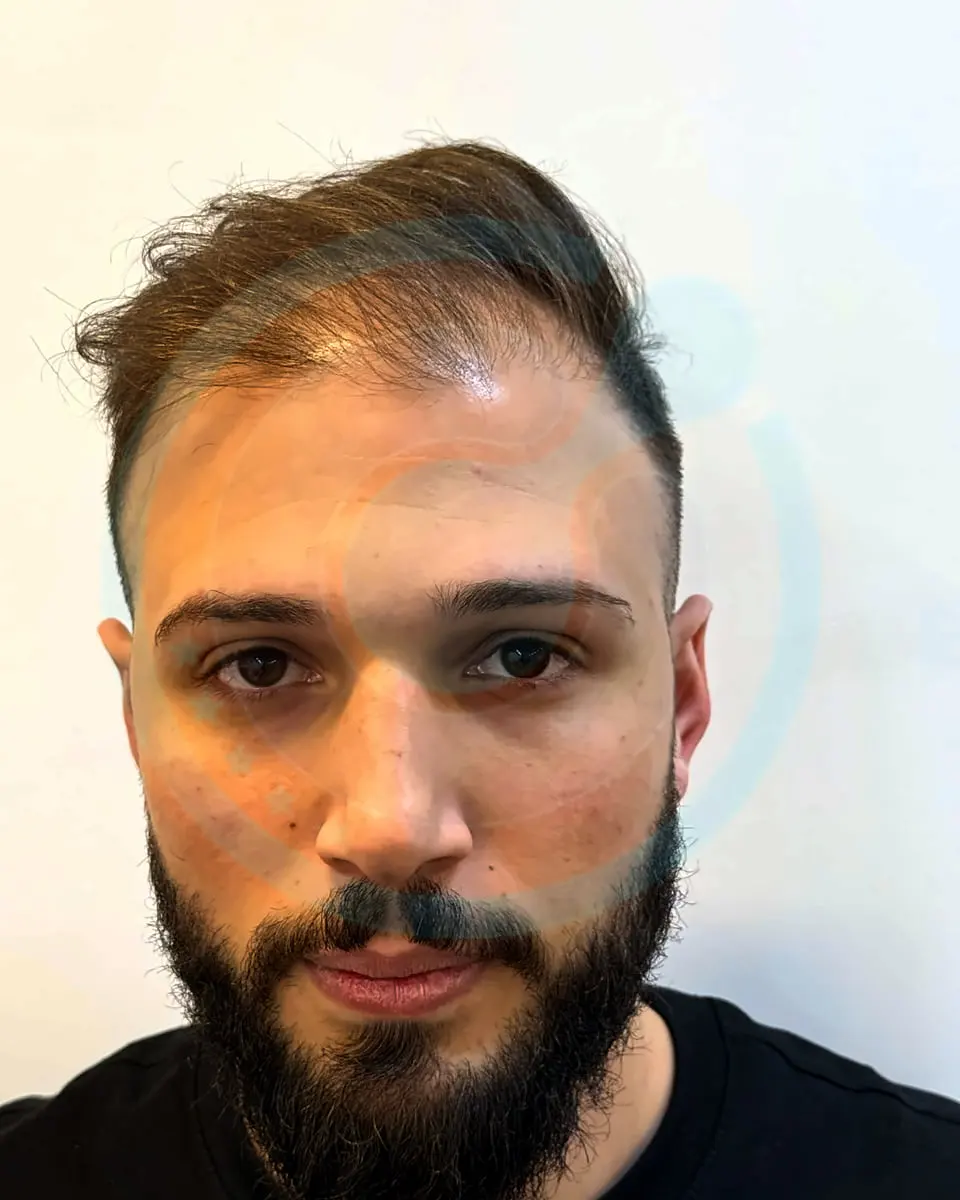 Prima e dopo un trapianto di capelli, paziente reale di BlueMagic Group, 4.200 innesti, DHI, 2 sessioni, 12 mesi