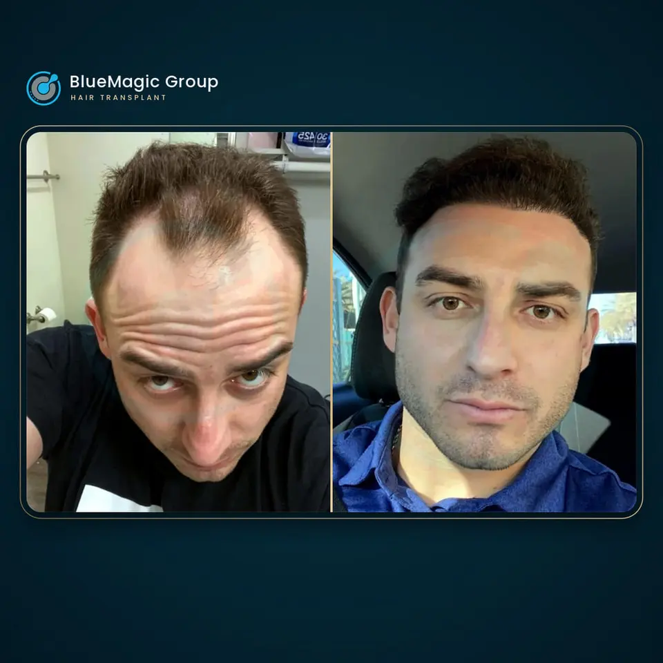 Prima e dopo un trapianto di capelli, paziente reale di BlueMagic Group