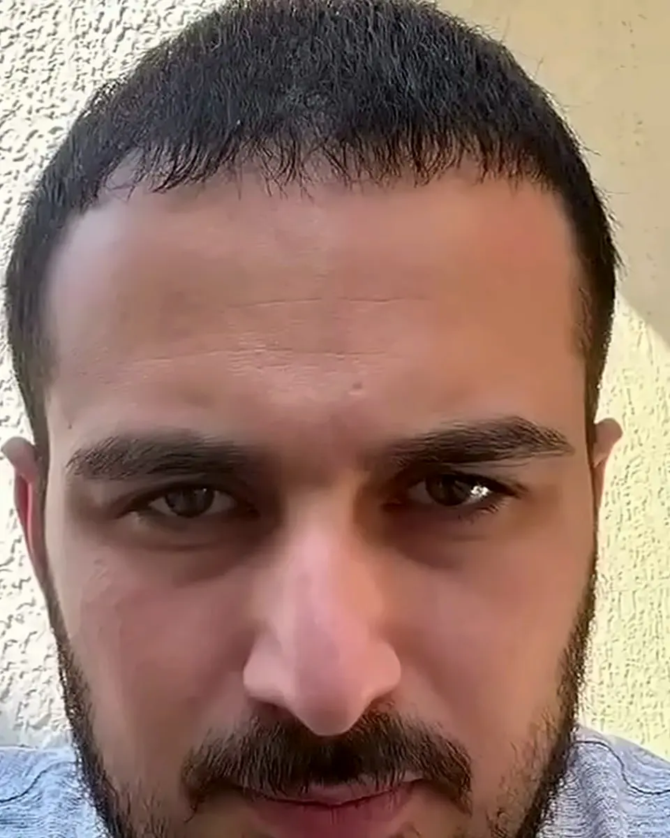 Prima e dopo un trapianto di capelli, paziente reale di BlueMagic Group, 5.000 innesti, 7 mesi