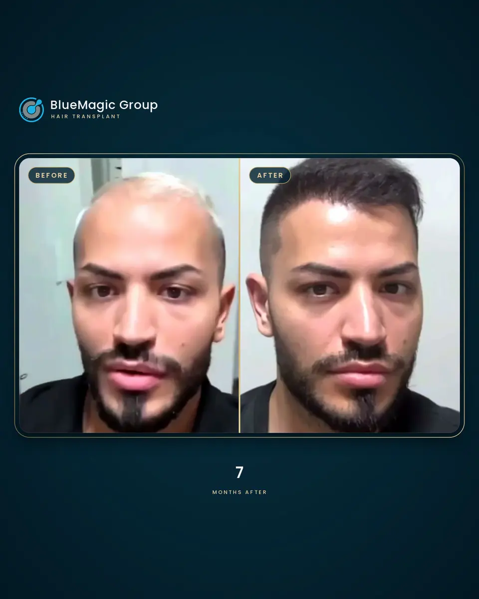 Prima e dopo: un paziente reale di BlueMagic Group, 7 mesi