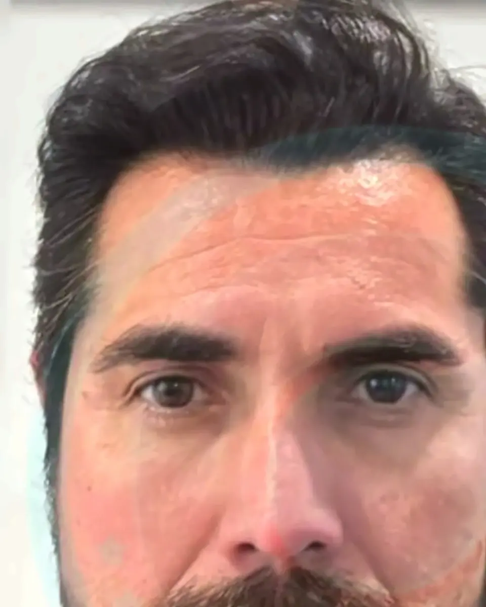 Prima e dopo un trapianto di capelli, paziente reale di BlueMagic Group
