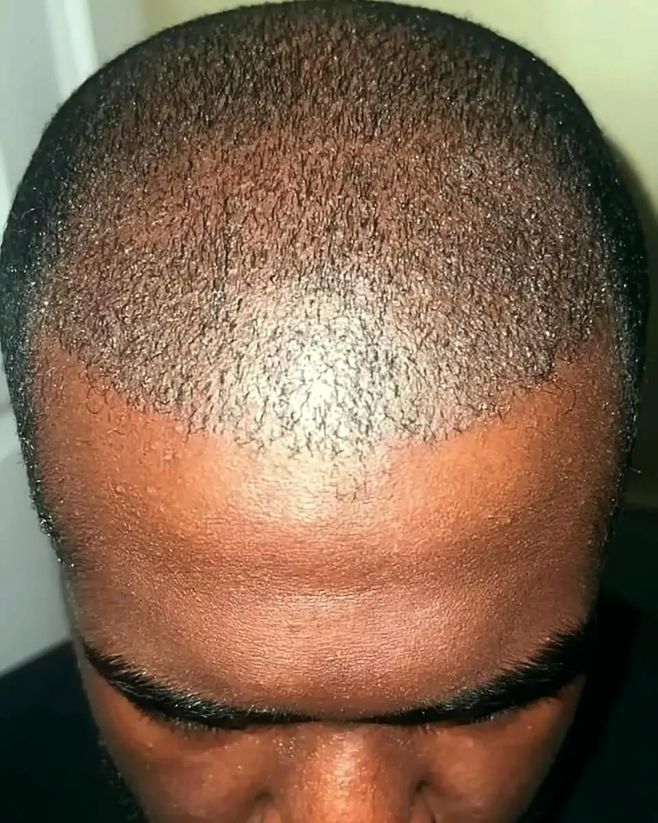 Prima e dopo un trapianto di capelli, paziente reale di BlueMagic Group