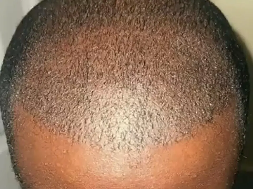 Un vertice con capelli afro dopo un trapianto di capelli
