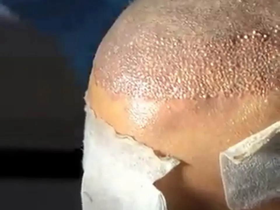 Un cuoio capelluto appena trapiantato, con la medicazione sulla fronte