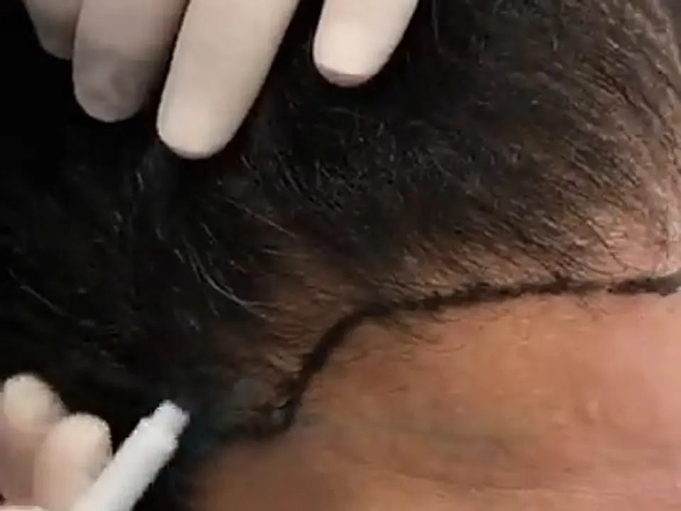 Un medico disegna l’attaccatura di una donna tra i suoi capelli