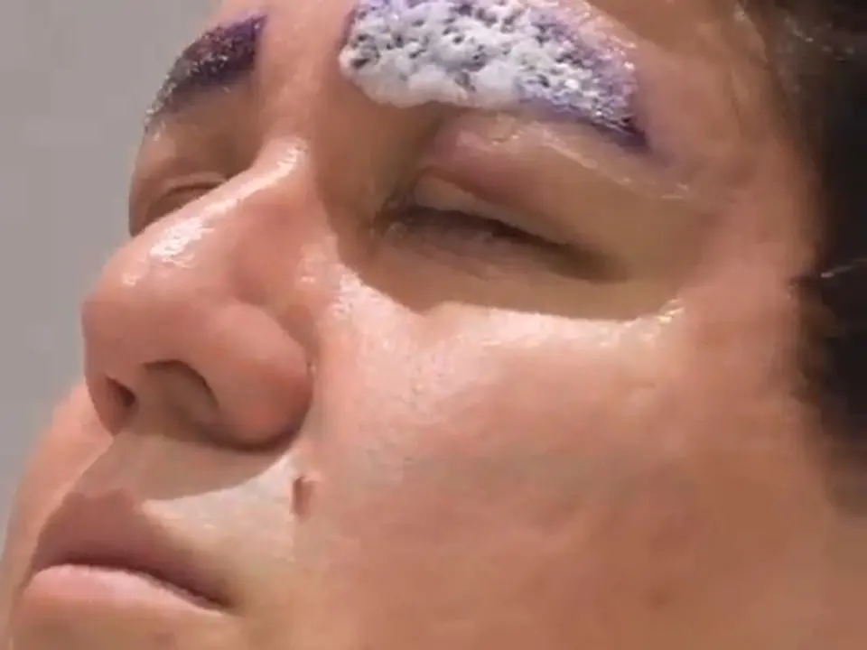 Sopracciglia subito dopo un trapianto di sopracciglia