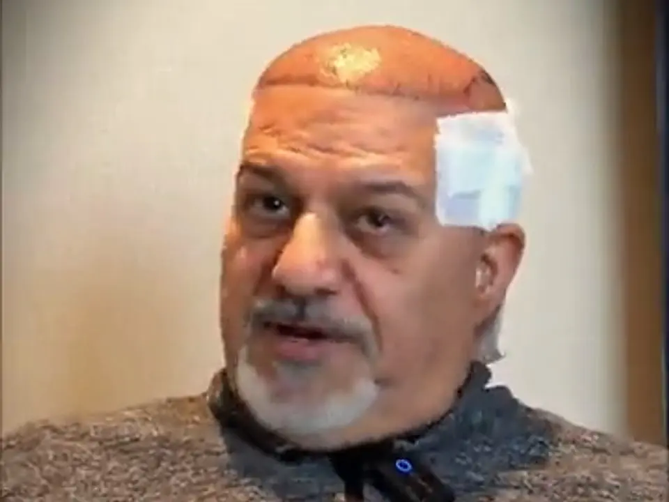 Un paziente arrivato dopo un primo trapianto fatto altrove