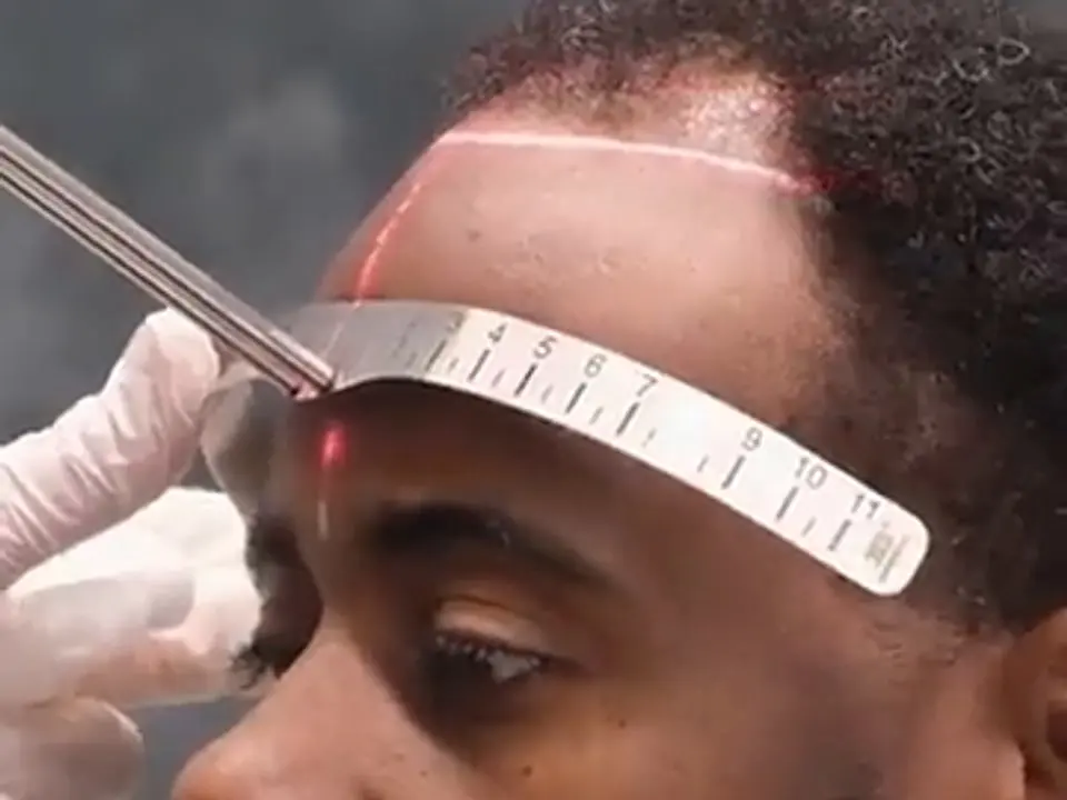 Misurazione dell’attaccatura su un paziente con capelli afro