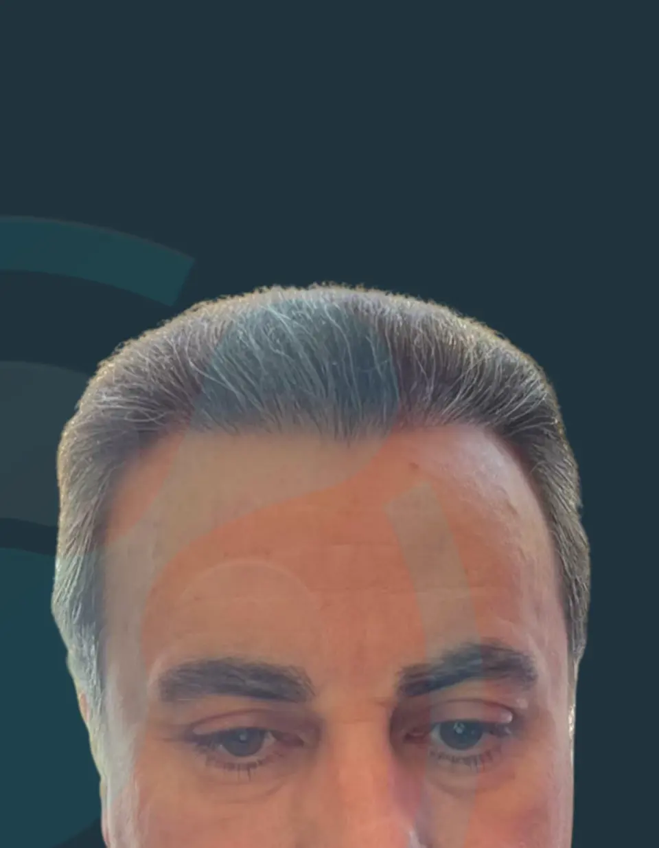 Pas — Vija e flokëve dhe dendësia