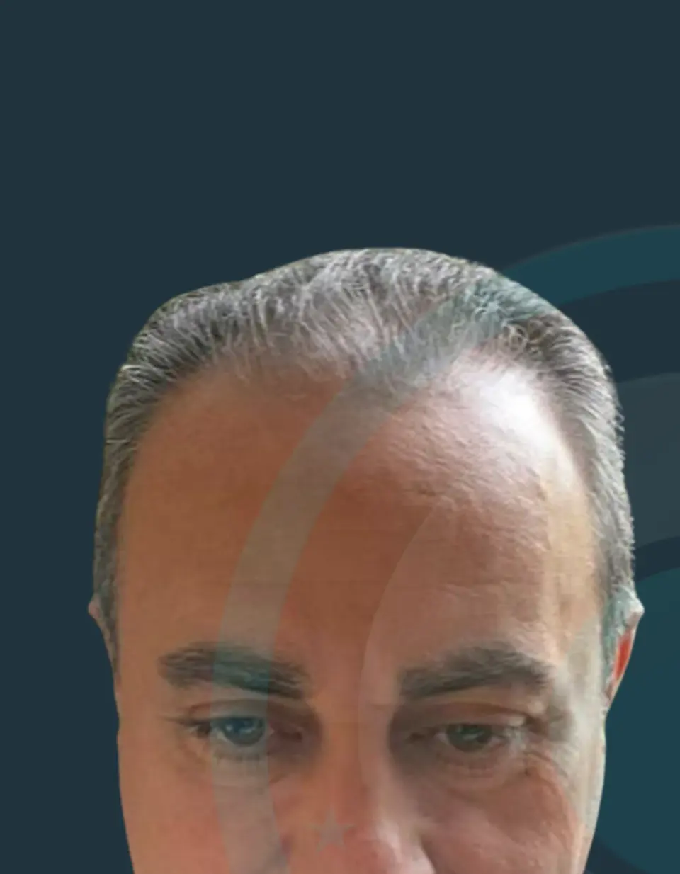 Para — Vija e flokëve dhe dendësia